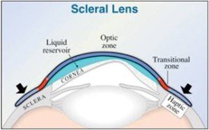 scleral lens flexture scleral lens flexture