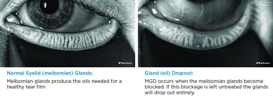 dry eye treatment